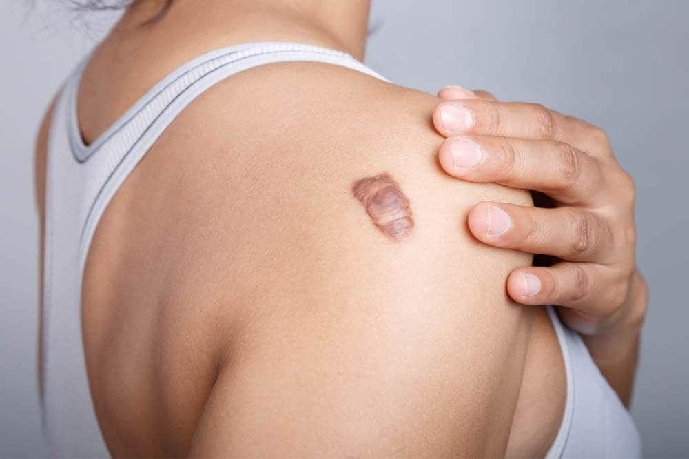 Mujer con cicatriz marcada
